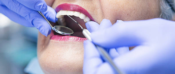 Best Emergency Dentist for Lost Fillings or Crowns in Winter Gardens, CA