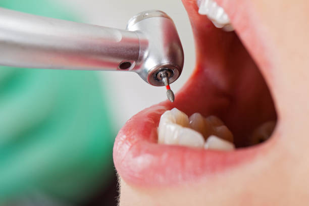 Best Emergency Root Canal Treatment in Winter Gardens, CA